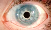 Implantes Corneales Avanzados
